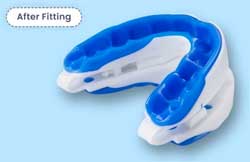 Fitted Mouthpiece Set to Stop Snoring