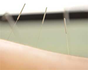 Acupuncture and Snoring