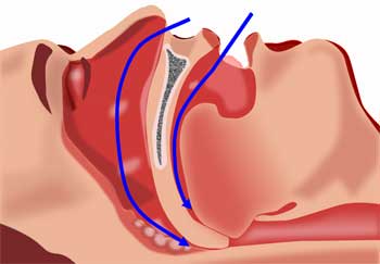 Nasal Passages and Breathing Airways that Affect Snoring - Is There Really a Stop Snoring Solution?