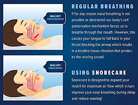 How Snore Vents Stop Snoring Naturally