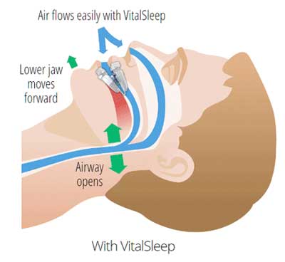 How to Stop Snoring Through Airflow Improvement with the VitalSleep Anti-Snore Mouthpiece
